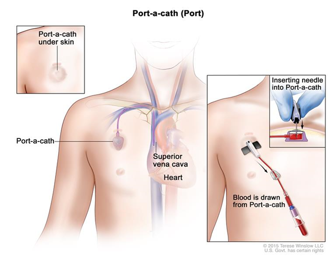 Port insertion : r/cancer